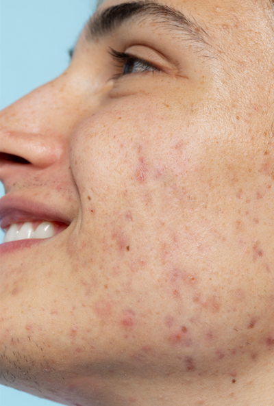 ACNE & BREAKOUTS